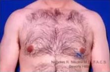 Real patient #1 Gynecomastia surgery after photo