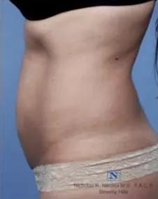 Real patient #1 Cellulite Treatment via BodyFx® before photo
