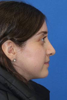 Real patient #1 Rhinoplasty procedure after photo
