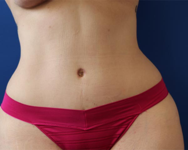 Real patient #2 Tummy Tuck procedure after photo