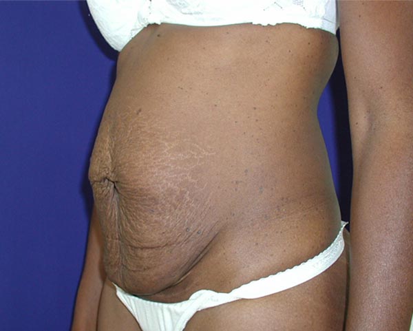 Real patient #1 Tummy Tuck procedure before photo