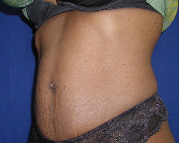 Real patient #1 Tummy Tuck procedure after photo