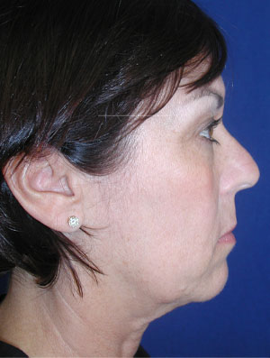 Real patient #2 Facelift procedure before photo