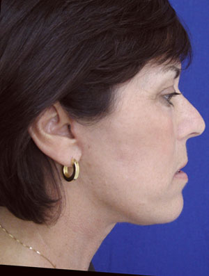 Real patient #2 Facelift procedure after photo