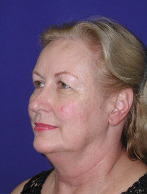 Real patient #1 Facelift procedure before photo