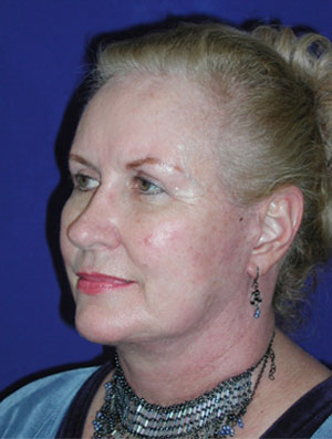 Real patient #1 Facelift procedure after photo