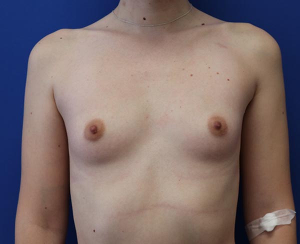 Real patient #2 Breast Augmentation procedure before photo