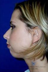 Real patient #1 Cheek and Chin procedures before photo