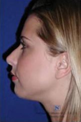Real patient #1 Cheek and Chin procedures after photo
