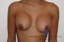 Real patient #1 Breast Implant Replacement surgery before photo