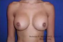 Real patient #1 Breast Implant Replacement surgery after photo