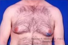 Real patient #1 Gynecomastia surgery before photo