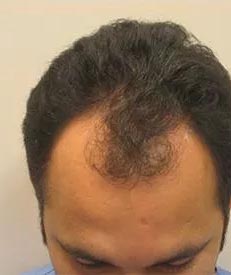 Real patient #1 Neograft Fue Hair Transplant before photo