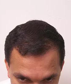 Real patient #1 Neograft Fue Hair Transplant after photo