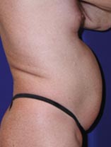 Real patient #1 Liposuction procedure before photo